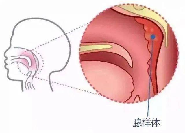「腺样体」也叫咽扁桃体或增殖体,位于鼻咽部顶部与咽后壁处,属于淋巴