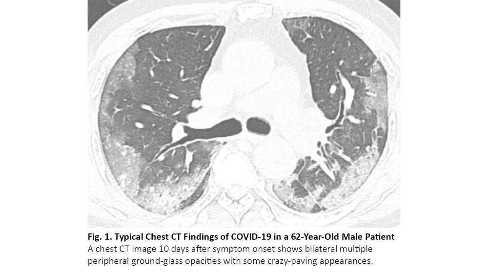 当肺癌患者感染covid-19,胸部ct如何鉴别?