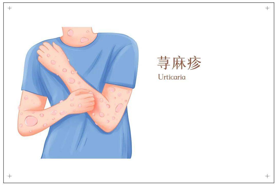 冬季谨防寒冷性荨麻疹预防要点请牢记