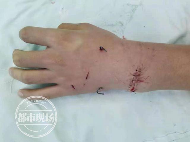 江西:高一学生手腕被人砍断!起因是女同学给他取外号