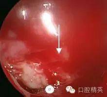 根尖囊肿并发上颌窦感染误诊1例