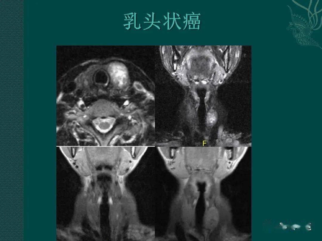 淋巴结囊性变及壁内明显强化的乳头状结节是甲状腺乳头状癌的特征.