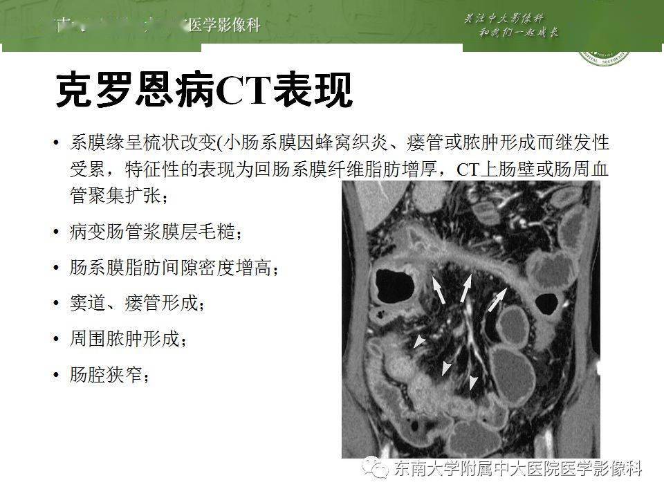 肠管丨右半结肠克罗恩病