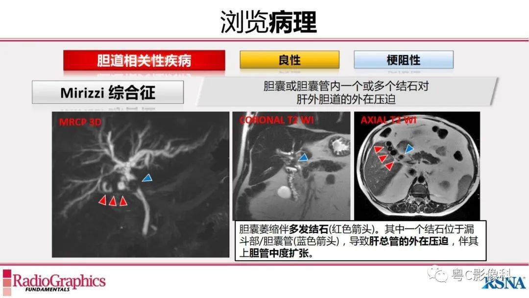 磁共振胰胆管成像mrcp放射科医生必须知道的专业知识