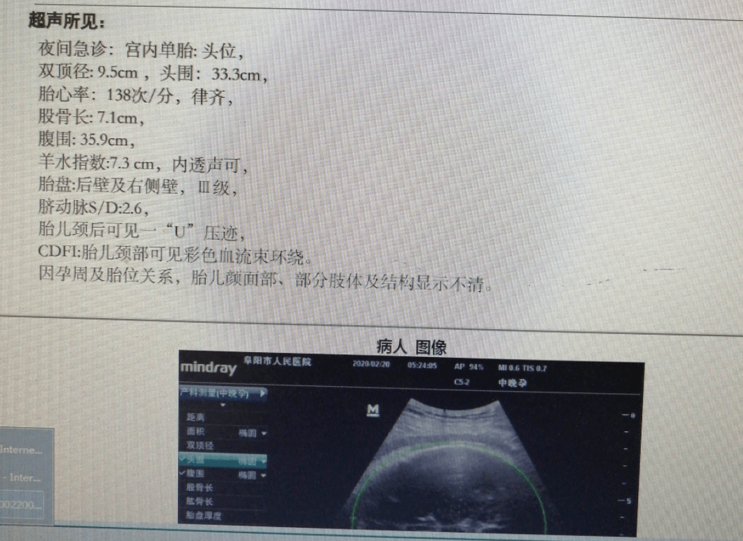 胎膜早破,宫颈评分低,缩宫素应该如何使用?