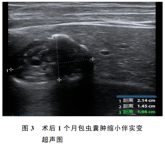 3 讨论 肝包虫囊肿棘球蚴在宿主器官定居发育形成囊肿 的过程中,诱发