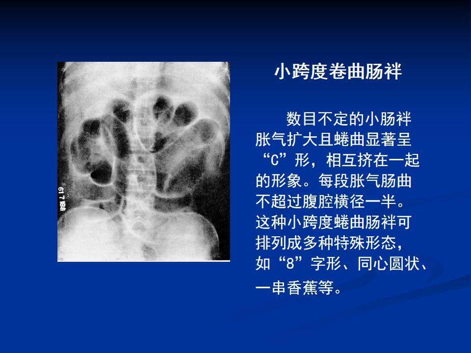 详细肠梗阻的分类及影像学表现高清图片文字讲解