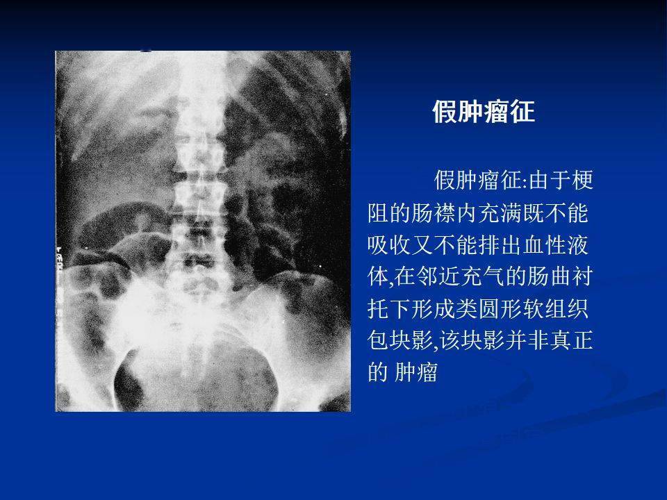 肠梗阻的分类及影像学表现(高清图片 文字讲解!_腹部