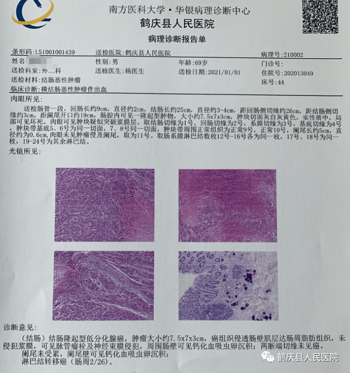 鹤庆县人民医院外二科成功开展2例腹腔镜结直肠肿瘤根治术_云南省