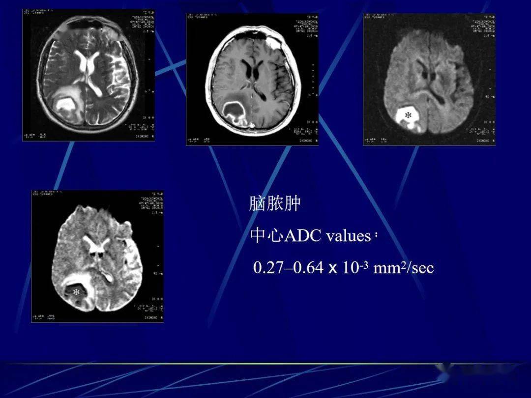 头颅mri中不同序列dwi和adc的区别
