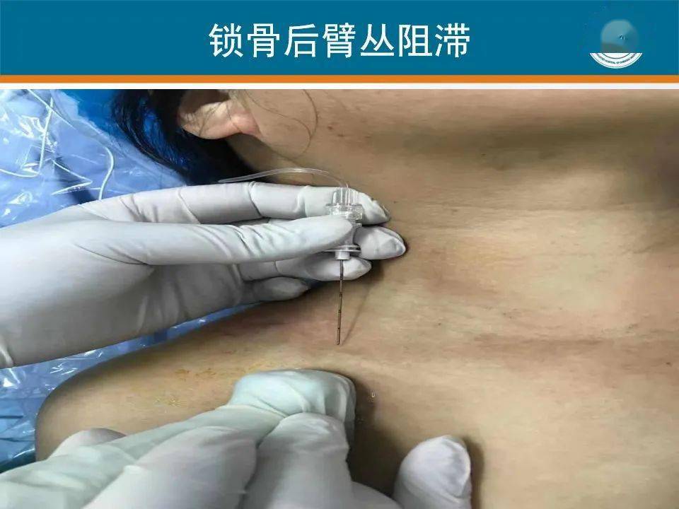 锁骨后与锁骨上臂丛神经阻滞用于上肢远端手术:一项随机,对照,单盲