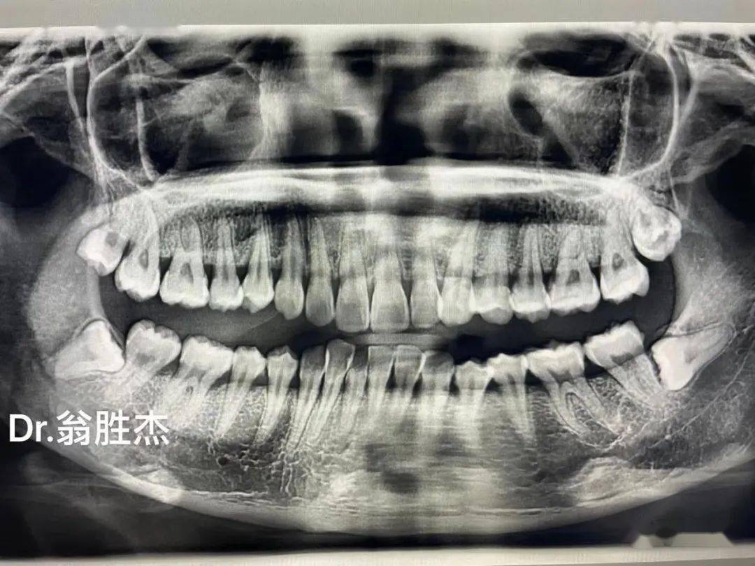 病例5:同侧智齿,下颌埋伏阻生 拔除