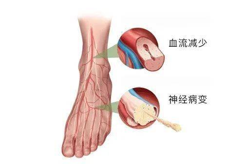 健康知识糖尿病患者都害怕用热水袋原因竟是