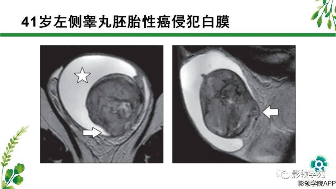 睾丸肿瘤mri诊断