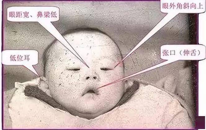 什么情况会生出唐宝宝? 唐氏综合征并非遗传性疾病,且不会传染.