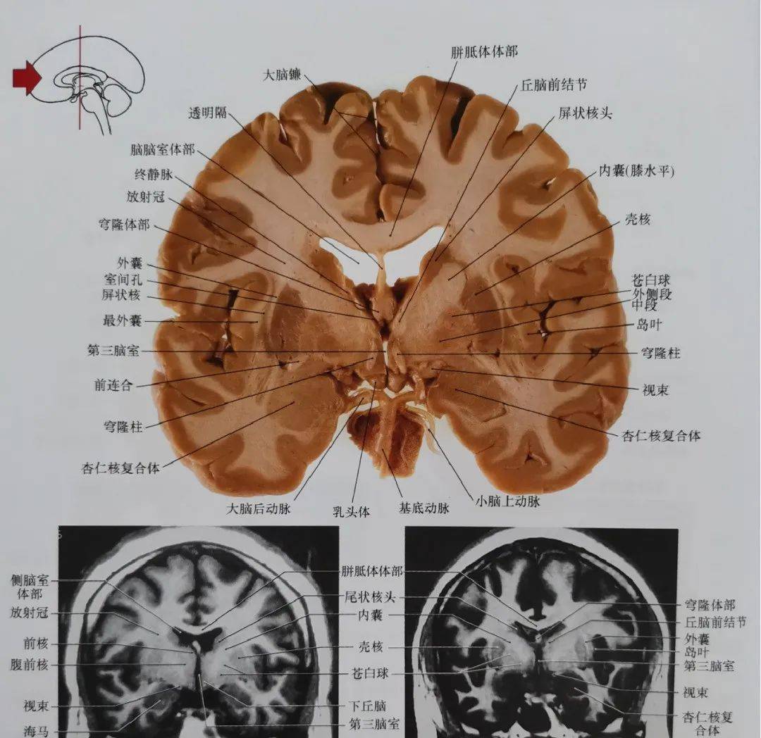 与图1相比,尾状核显示较小,苍白球比较明显,内侧邻近壳核.