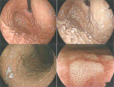 【增生性息肉】18.【疣状胃炎】17.【鸡皮样胃炎】16.
