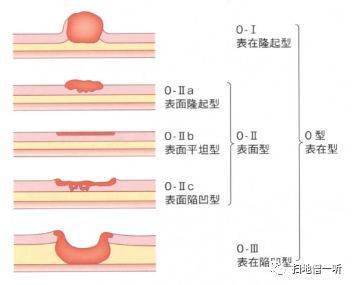 7.【食管表浅癌】(巴雷特食管)6.【barrett食管】5.