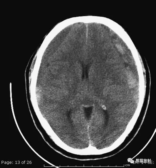 简明又详细的头部ct读片详解,收藏_脑室