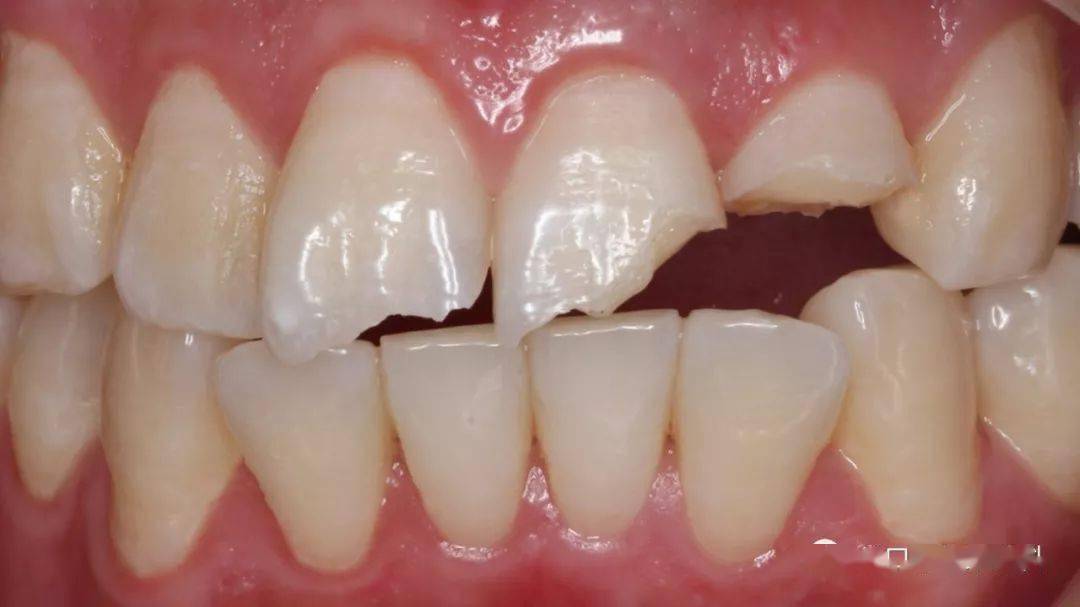 【病例分享】复合树脂修复前牙外伤一例