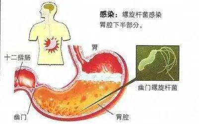 1,胃胀,胃痛:幽门螺杆菌广泛分布于胃内,可以产生多种毒素和因子破坏