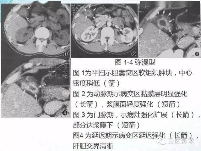 胆囊腺肌症影像表现及鉴别