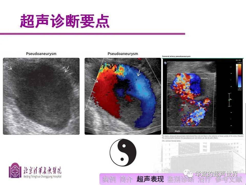 文献学习与病例讨论:超声在医源性股动脉假性动脉瘤诊疗中的应用