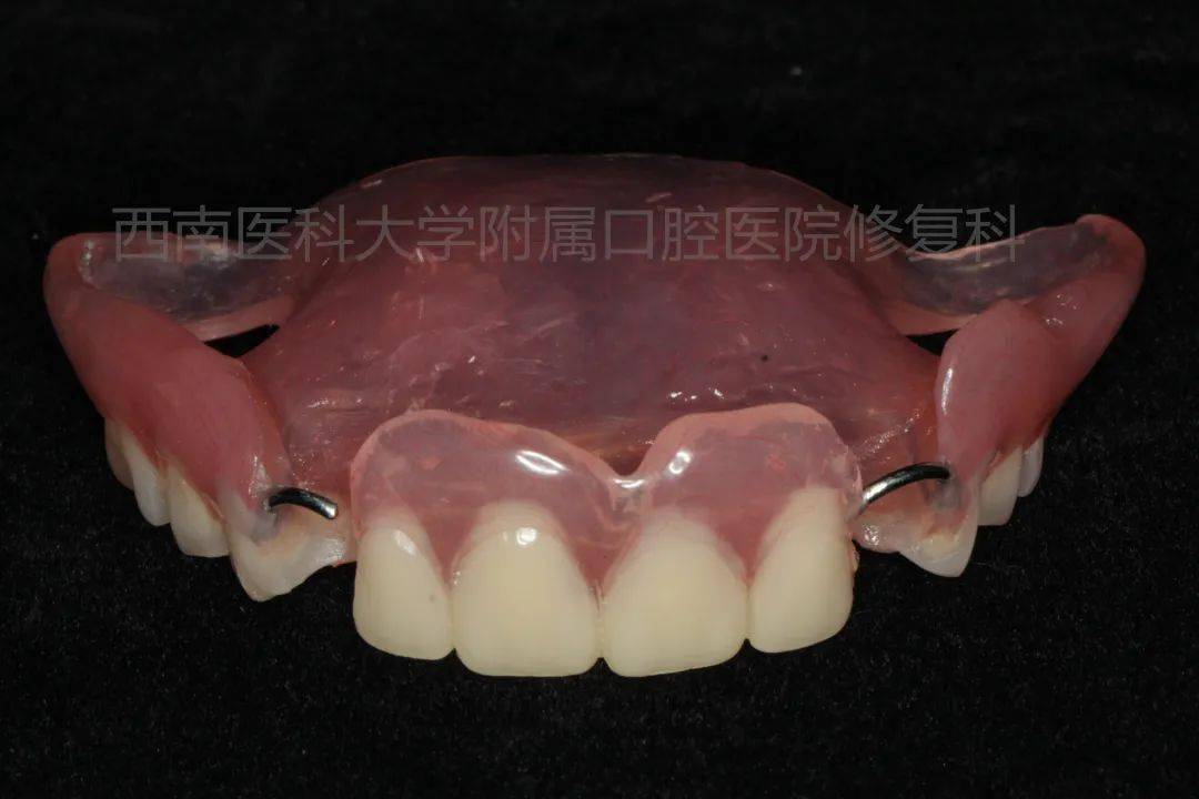 修复科郭玲教授接诊年龄最小的活动假牙患儿