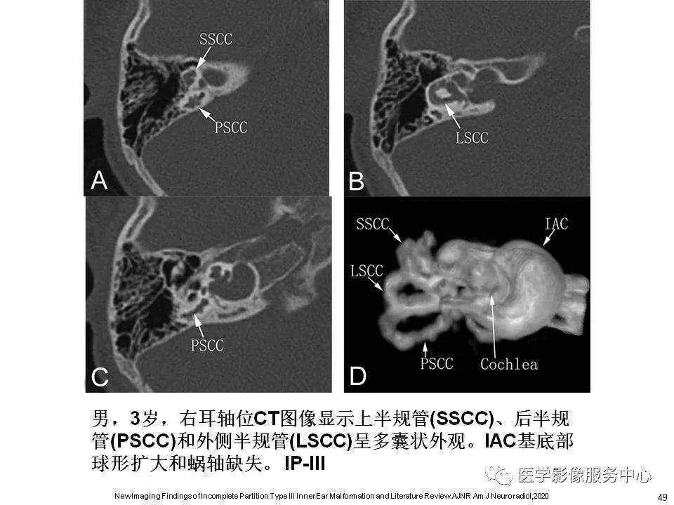 本文目录 第一部分:耳蜗解剖  第二部分:内耳畸形分类,主要基于ct