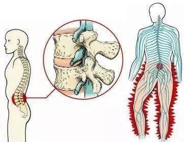 很多时候腰疼可能是腰肌劳损,腰背肌筋膜炎,腰椎小关节突功能紊乱