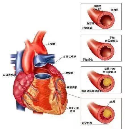 关于冠心病,你真的了解吗?_主动脉