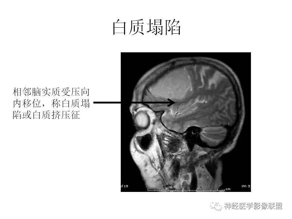 影像总结丨脑膜三件套——脑膜瘤,hpc/sft