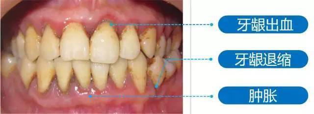 牙龈不健康的几大表现,你中招了吗?