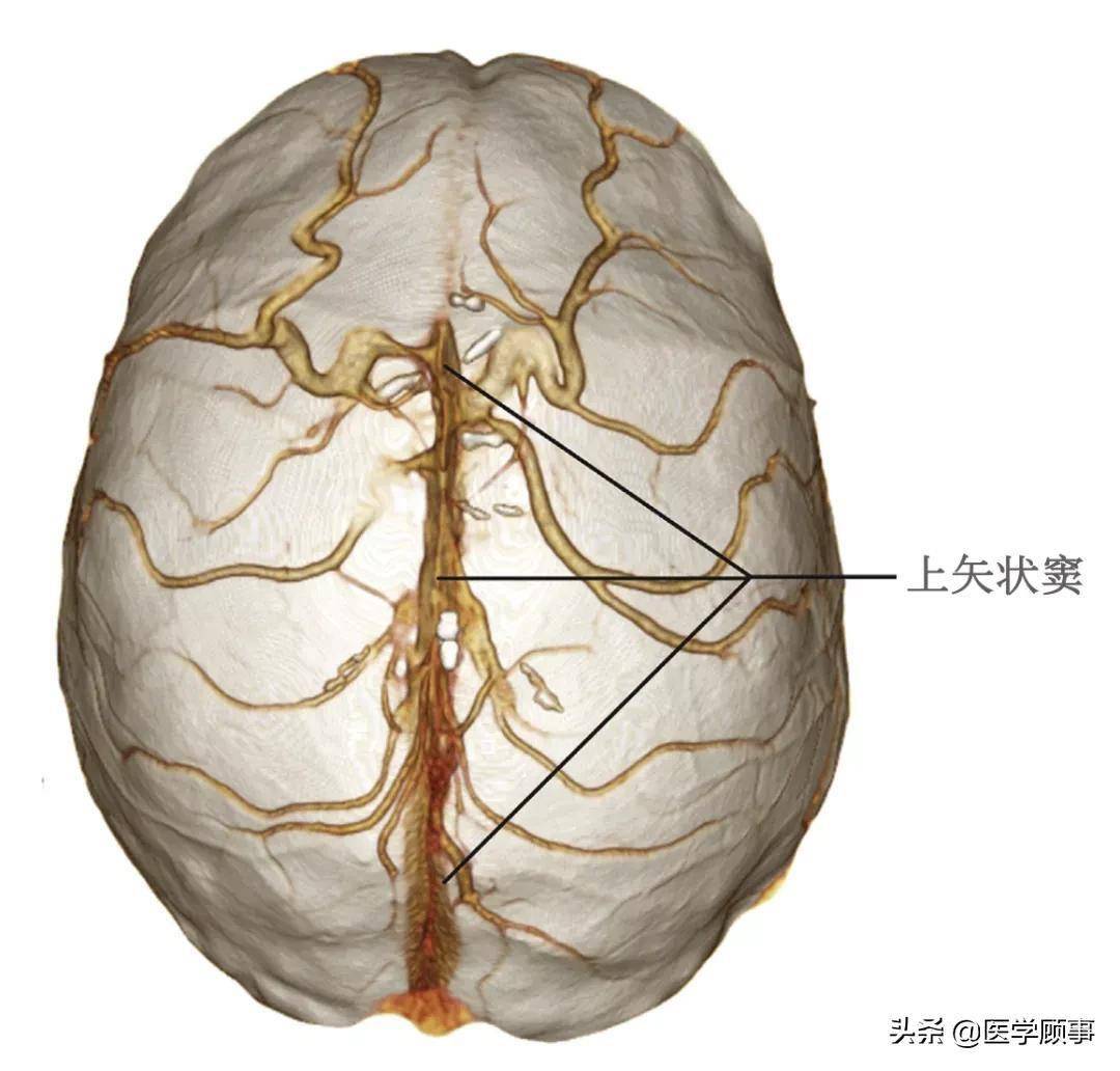 3,额部矢状窦缺失:该类较常见,冠状缝前的矢状窦缺失,双侧额部有粗大