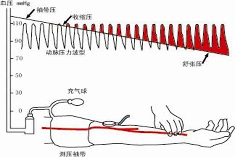 5有惺嬲叛(dbp)其重要性是维持冠状动脉灌注压(ccp),因为cpp=dbp