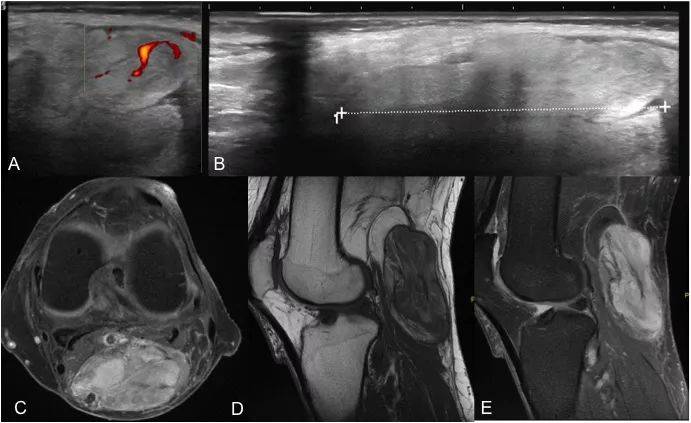 23种腘窝肿块影像荟萃