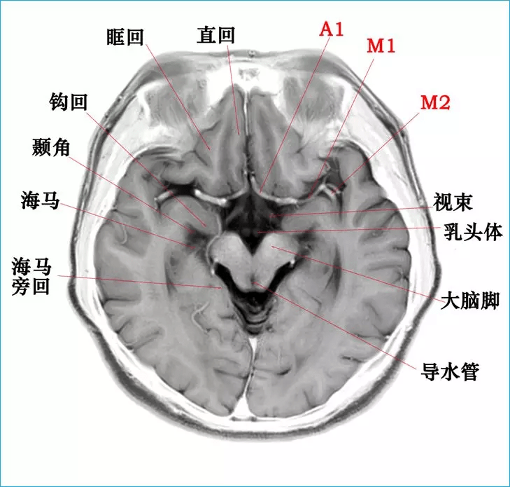 影像必备:高清颅脑mr断层解剖图谱