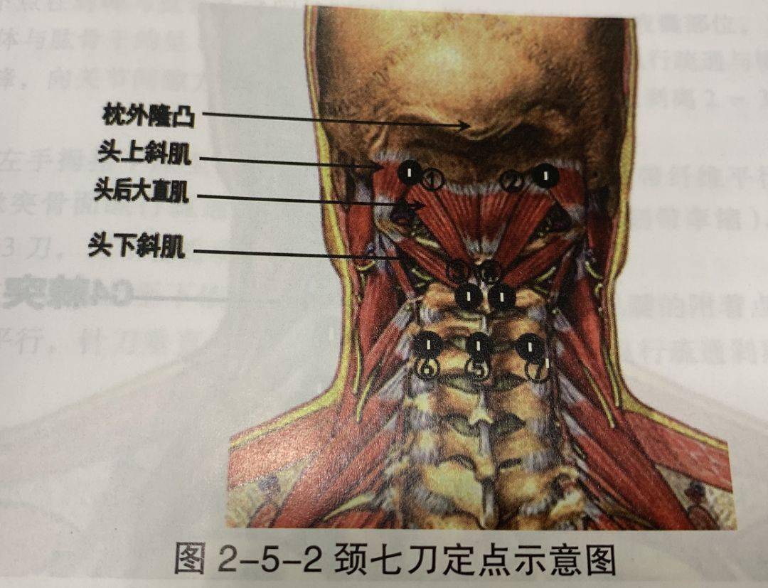 枕下肌群的重要性之颈七刀,颈六刀