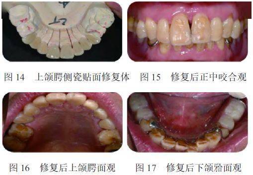 一周复诊,试支架,根据息止颌间隙确定正常的垂直距离,制取颌位记录,将