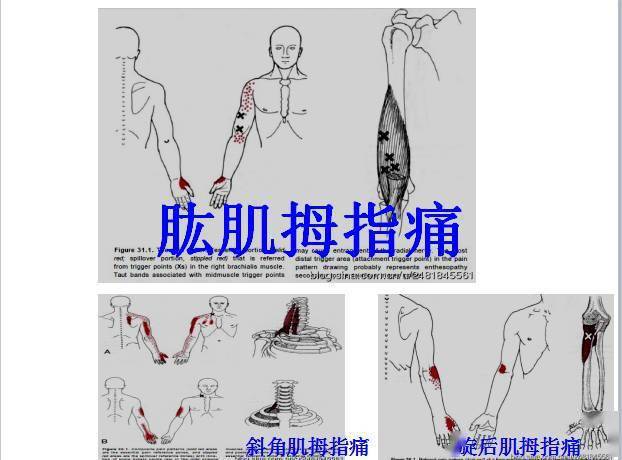 桡侧腕长伸肌(extensor carpi radialis longus)  肱桡肌(brachio