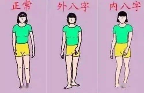 o型腿可以分为两种: 1,股骨外旋型
