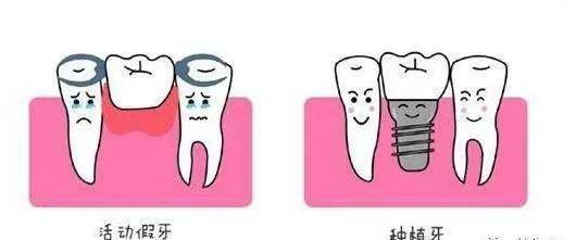 为什么我缺了一颗牙,医生却让镶我三颗?