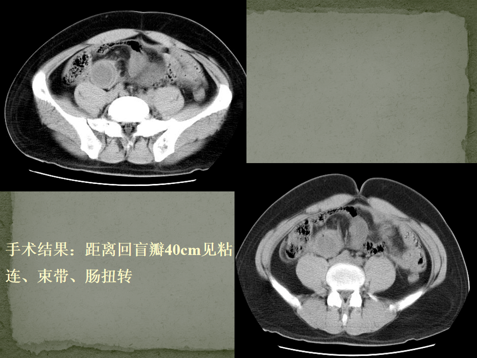 ct入门 | 肠梗阻的ct影像诊断