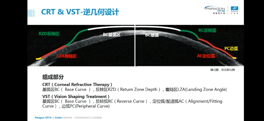 【揭秘】角膜塑形镜控制近视快速发展的原理是什么?