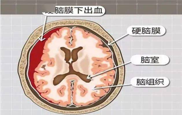 颅内出血血液积聚于硬脑膜下腔, 是颅内血肿中发病率最高者( 占40%).