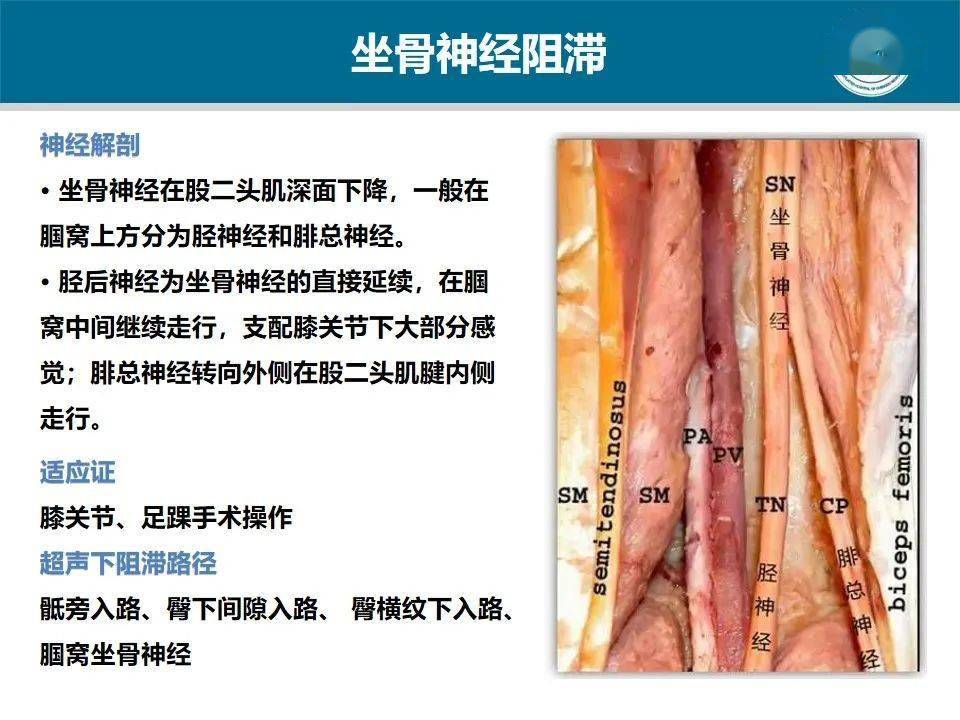 坐骨神经阻滞失败后神经刺激仪引导的补充性腘窝坐骨神经阻滞不会增加