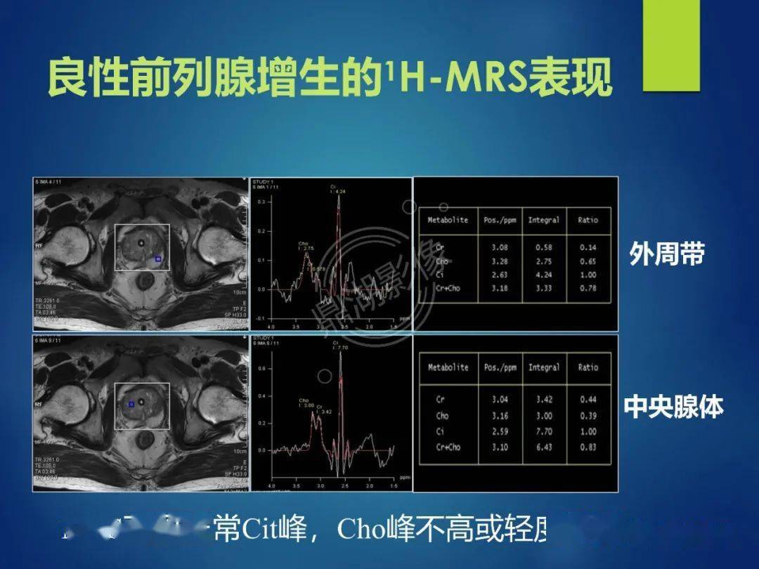 前列腺癌的磁共振成像诊断