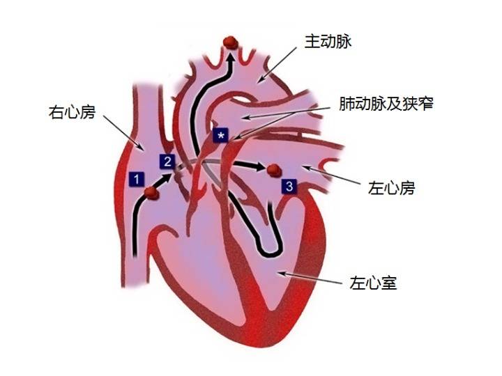 左心房;fo:卵圆孔;ss:继发隔)(图片由北京协和医院提供)