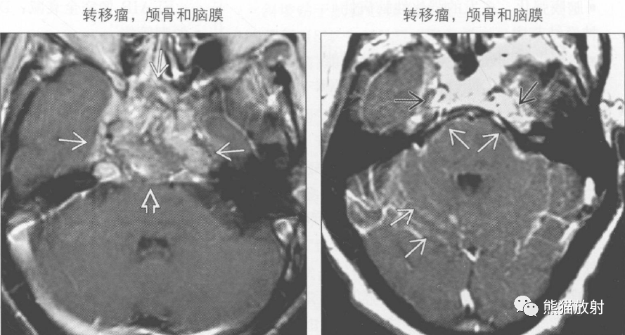 鉴别诊断丨桥前池肿块