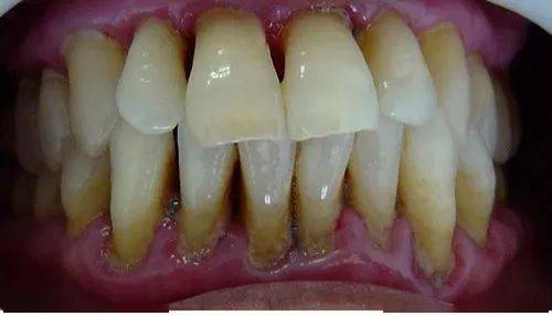 中期牙周炎:牙周袋进一步加深,牙齿松动,移位